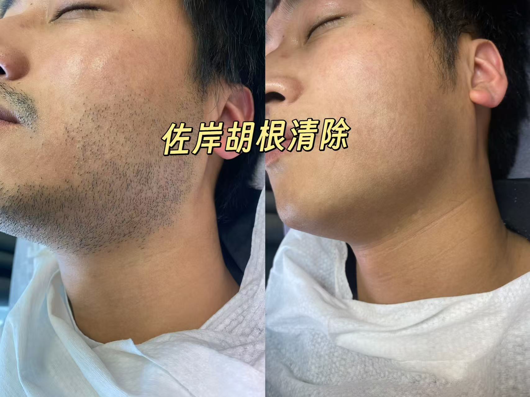 衢州脱胡子